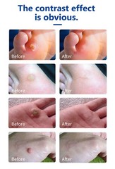 20G Reinreude Wart Remover Plantar Wart Removers for Corns Feet Body Fast Acting