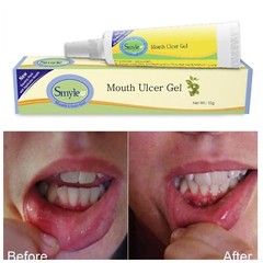 Smyle Mouth Ulcer Gel 10gm reduces the burning sensation & swelling