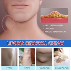 Fat Lipoma Soothing Cream InstantOintment Relieving 1*20g Agglomerat H8N2