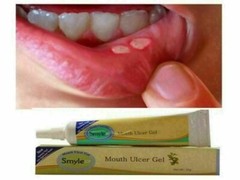 5 x Smyle mouth ulcer gel Ayurveda instant ulcer pain relief 10g usps