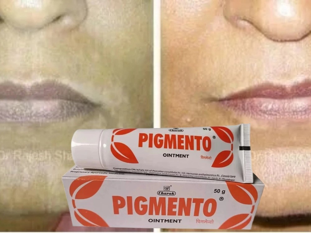 Charak Pigmento Ointment (50gm) for Vitiligo, Pigmentation 100% Herbal