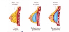 PUERARIA MIRIFICA Breast Enlargemen Big Boobs Butt Hips Enlargement Fem 200 Caps