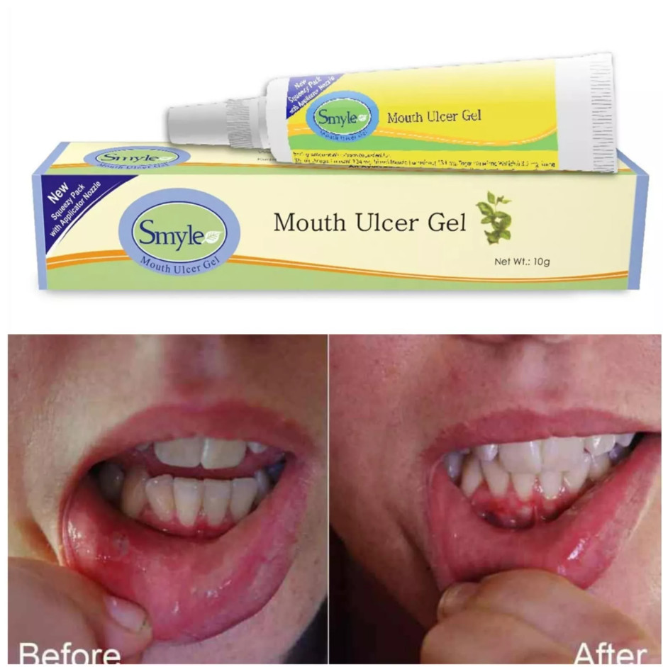 Smyle Mouth Ulcer Gel 10gm reduces the burning sensation & swelling