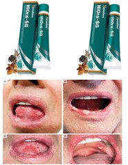 Himalaya Hiora-SG Gel For Mouth Ulcers Very Fast Free Delivery 10g X 2 Ex. 2026