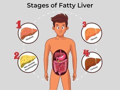 FATTY LIVER HUMAN DETOX CLEAN & REMOVE FAT – TREAT PREVENT – MADE IN USA