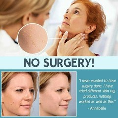 NEW SKIN TAG REMOVER CREAM SAFE FAST WART REMOVAL MOLE ACNE PIMPLE PATCH SPOT UK